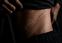 Job Scams: Pakistan Accused Of Organ Trafficking Bangladeshis Report Kidney Removal Job Scams: Pakistan Accused Of Organ Trafficking Bangladeshis Report Kidney Removal