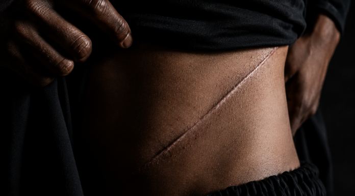 Job Scams: Pakistan Accused Of Organ Trafficking Bangladeshis Report Kidney Removal Job Scams: Pakistan Accused Of Organ Trafficking Bangladeshis Report Kidney Removal