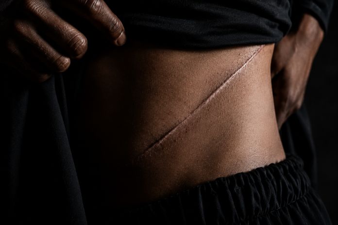 kidney removal Job Scams: Pakistan Accused Of Organ Trafficking Bangladeshis Report Kidney Removal