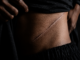 Job Scams: Pakistan Accused Of Organ Trafficking Bangladeshis Report Kidney Removal Job Scams: Pakistan Accused Of Organ Trafficking Bangladeshis Report Kidney Removal