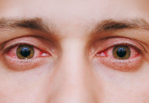 Eye Flu Infections Increase During Monsoon: 5 Symptoms That Need Attention Eye Flu Infections Increase During Monsoon: 5 Symptoms That Need Attention
