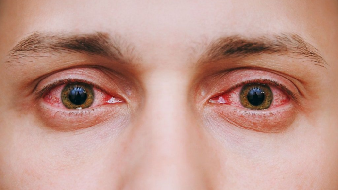 Eye Flu Infections Increase During Monsoon: 5 Symptoms That Need Attention