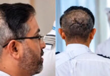 Stitches on his head, Pictures of Flydubai's 'hero pilot' Smit Machchhar go viral